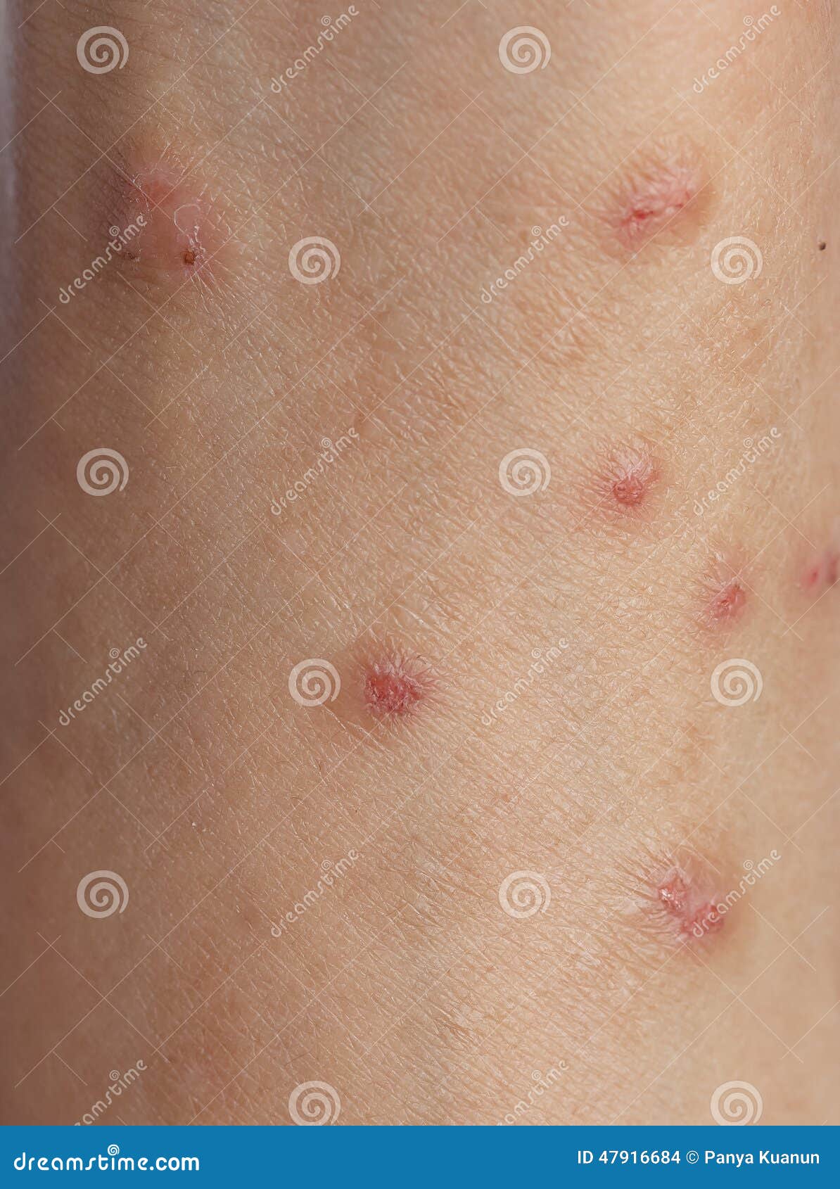 Skin Cancer Lesions On Arms