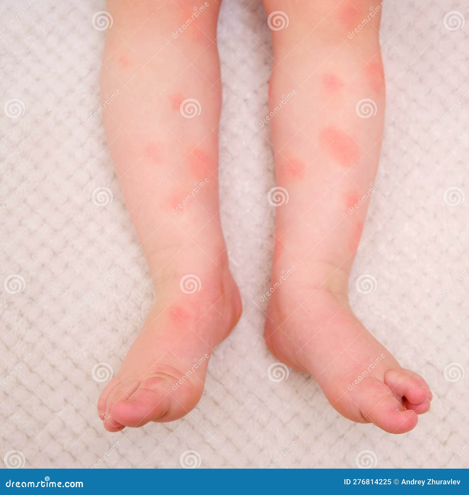 Allergies Et Dermatite Aux Soins Pour Bébé. Taches Rouges D ...