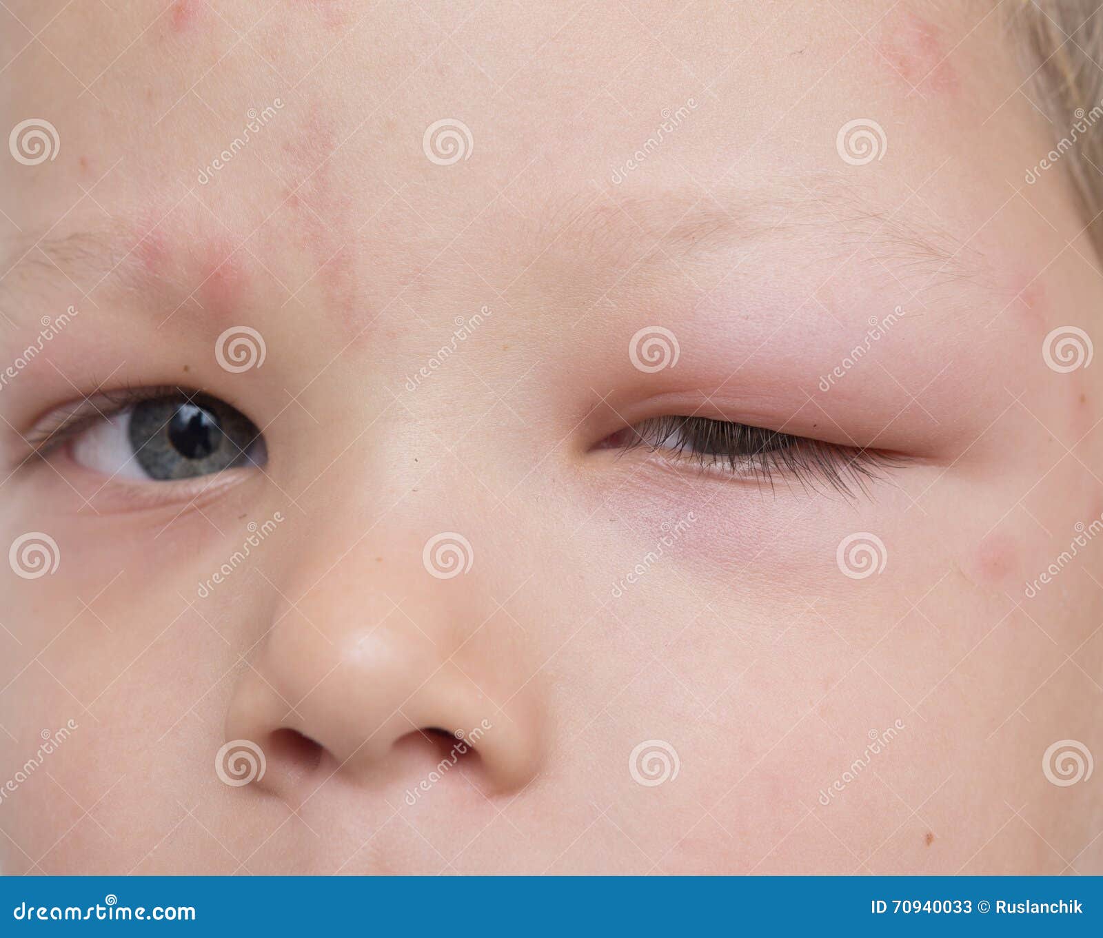 Allergy after mosquitoes stock image. Image of fever 70940033