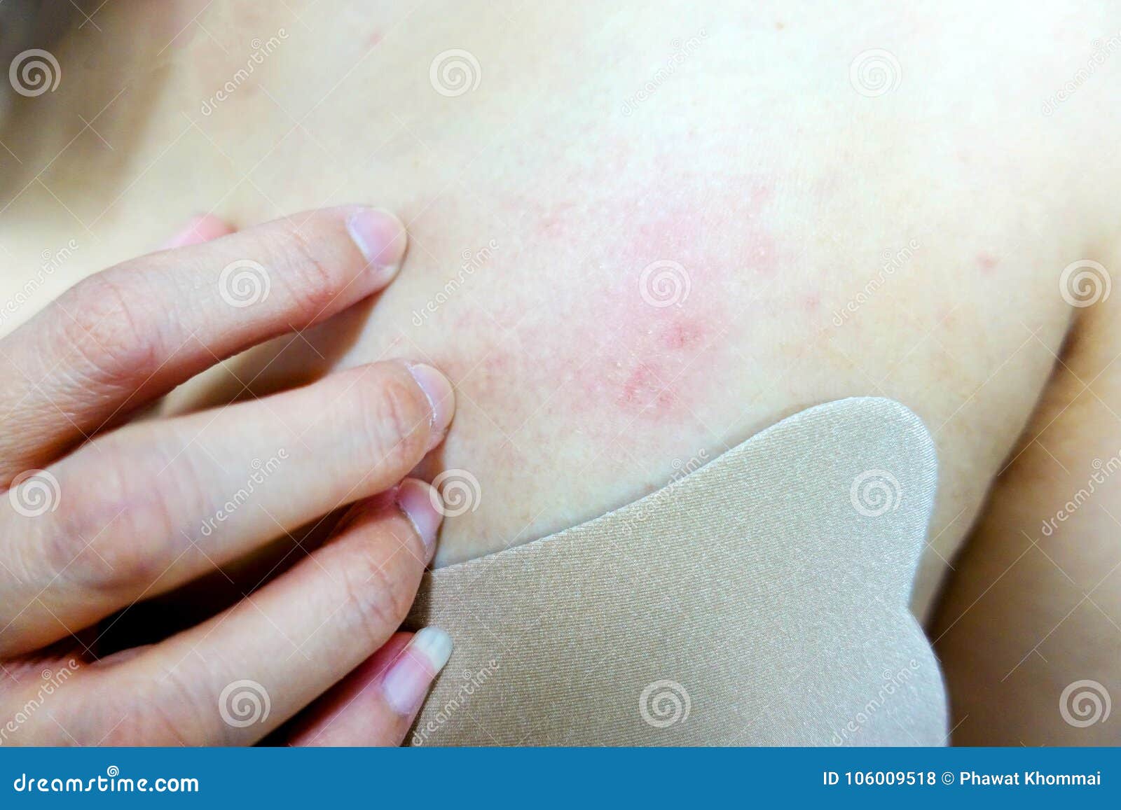 Allergy rash on the breast stock photo. Image of itch - 106009518