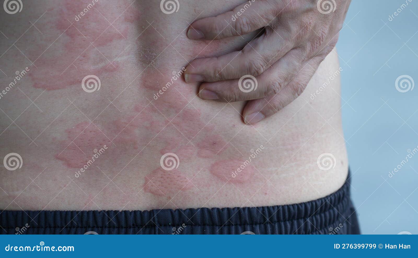 Allergy or Urticaria or Hives or Kaligata on Back Stock Image Image