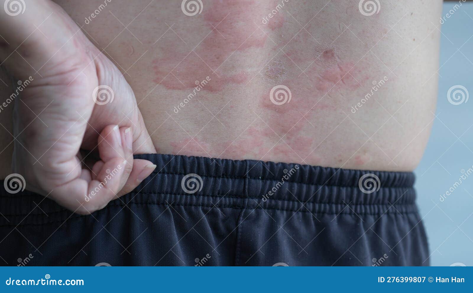 Allergy or Urticaria or Hives or Kaligata on Back Stock Image Image