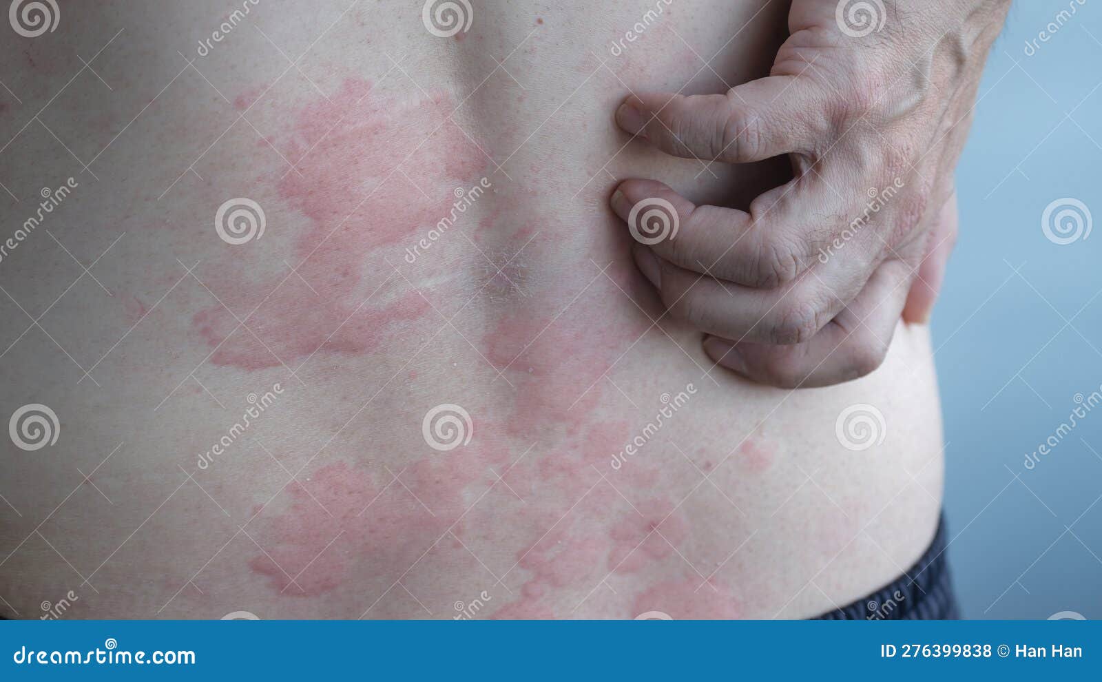 Urticaria Or Hives On The Back On The Shoulder Red Rashes Itchy Bumps