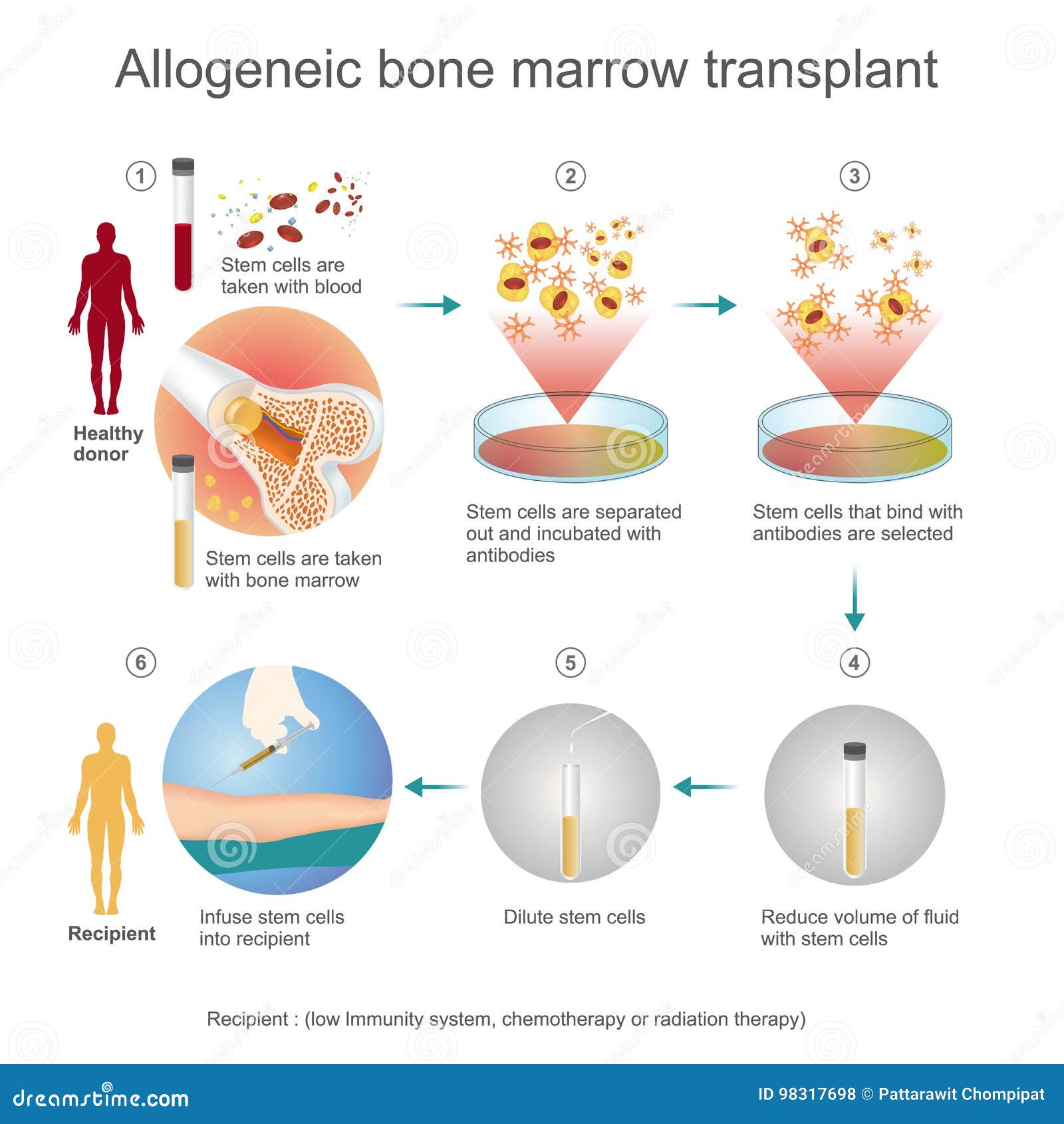 autologous stem cell transplant cure autologous stem cell transplant cure