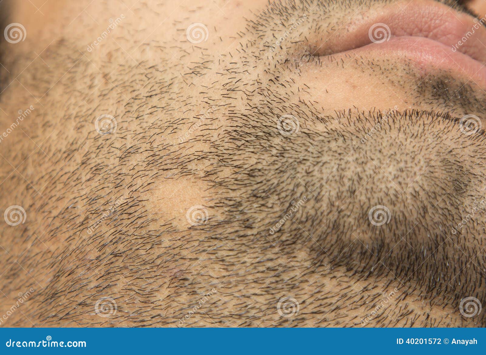 Alopecia Facial Hair 20