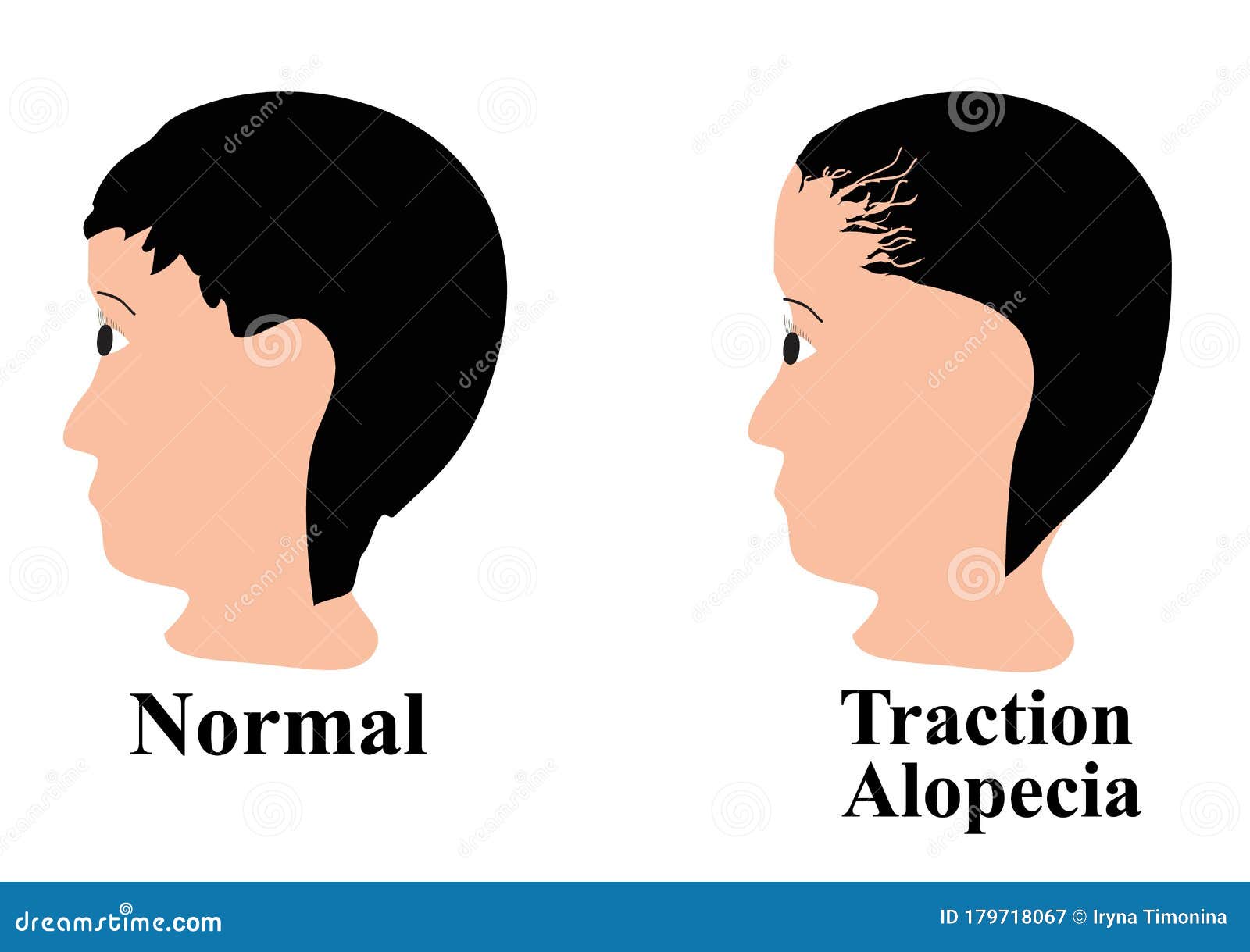 Alopecia Hair. Baldness of Hair on the Head. Traction Alopecia.  Infographics Stock Vector - Illustration of graphic, adult: 179718067