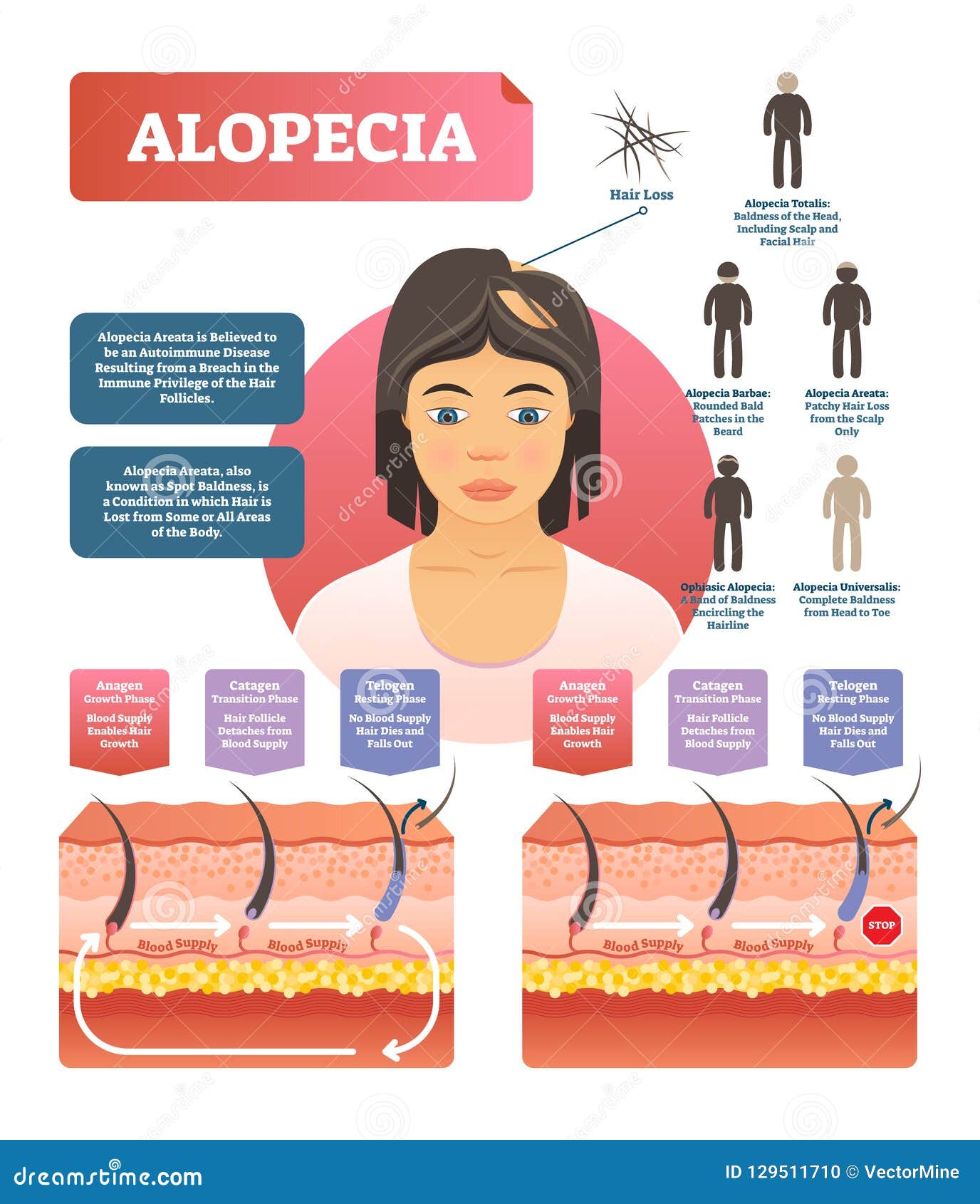 alopecia - hair loss autoimmune disease medical  diagram 