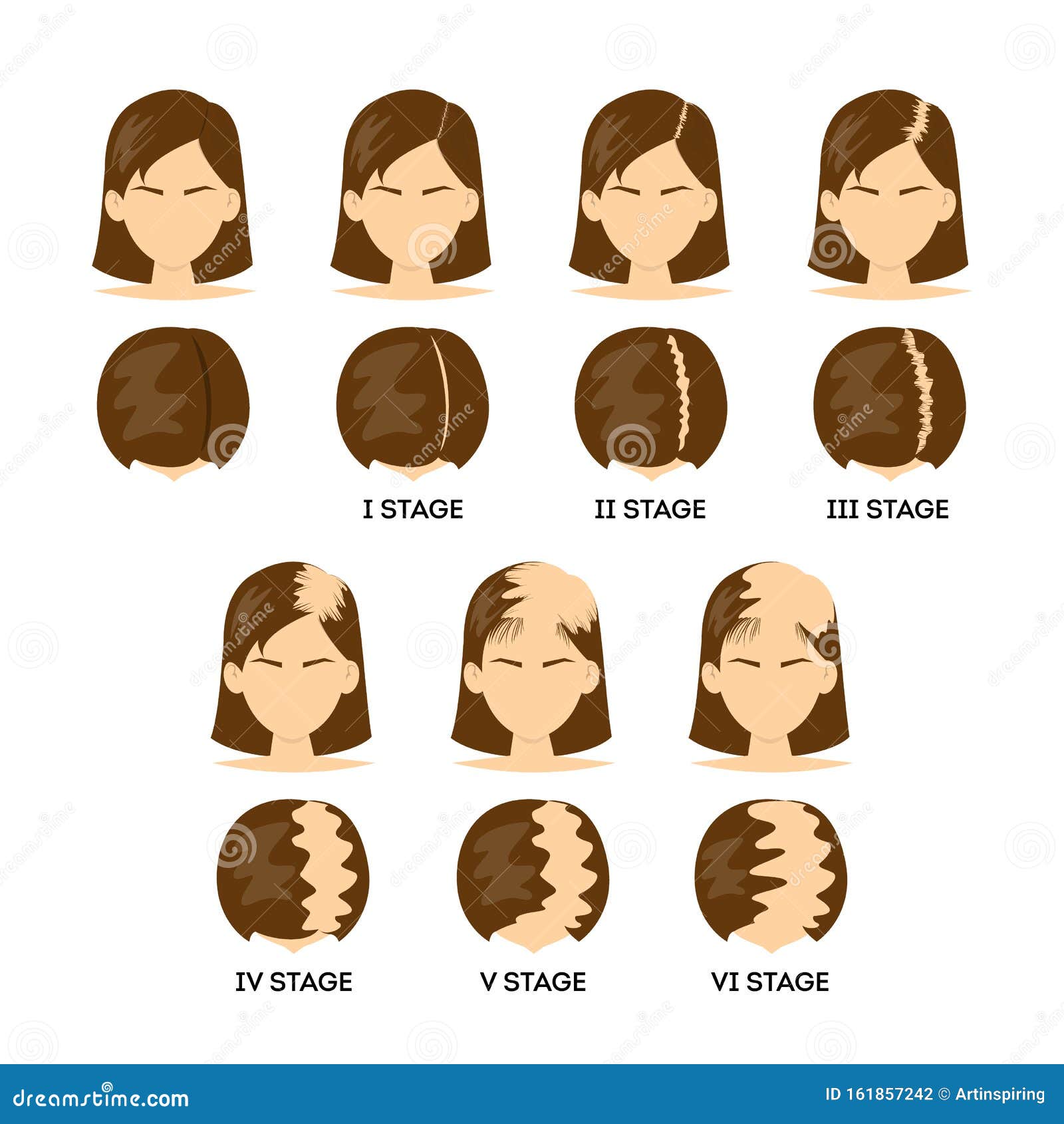 Alopecia Stages Set. Female Balding in Process. Stock Vector - Illustration  of hairstyle, healthcare: 161857242