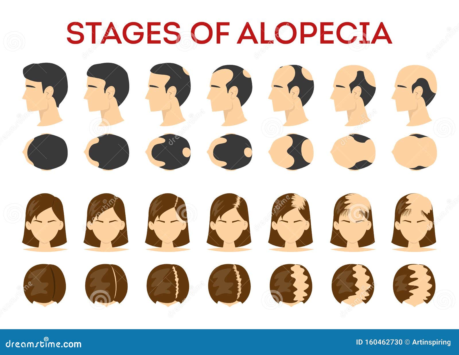 Alopecia Stages Set. Hair Loss, Balding Process Stock Vector - Illustration of hairstyle, head: 160462730 Alopecia Stages Set. Hair Loss, Balding Process Stock Vector - Illustration of hairstyle, head: 160462730