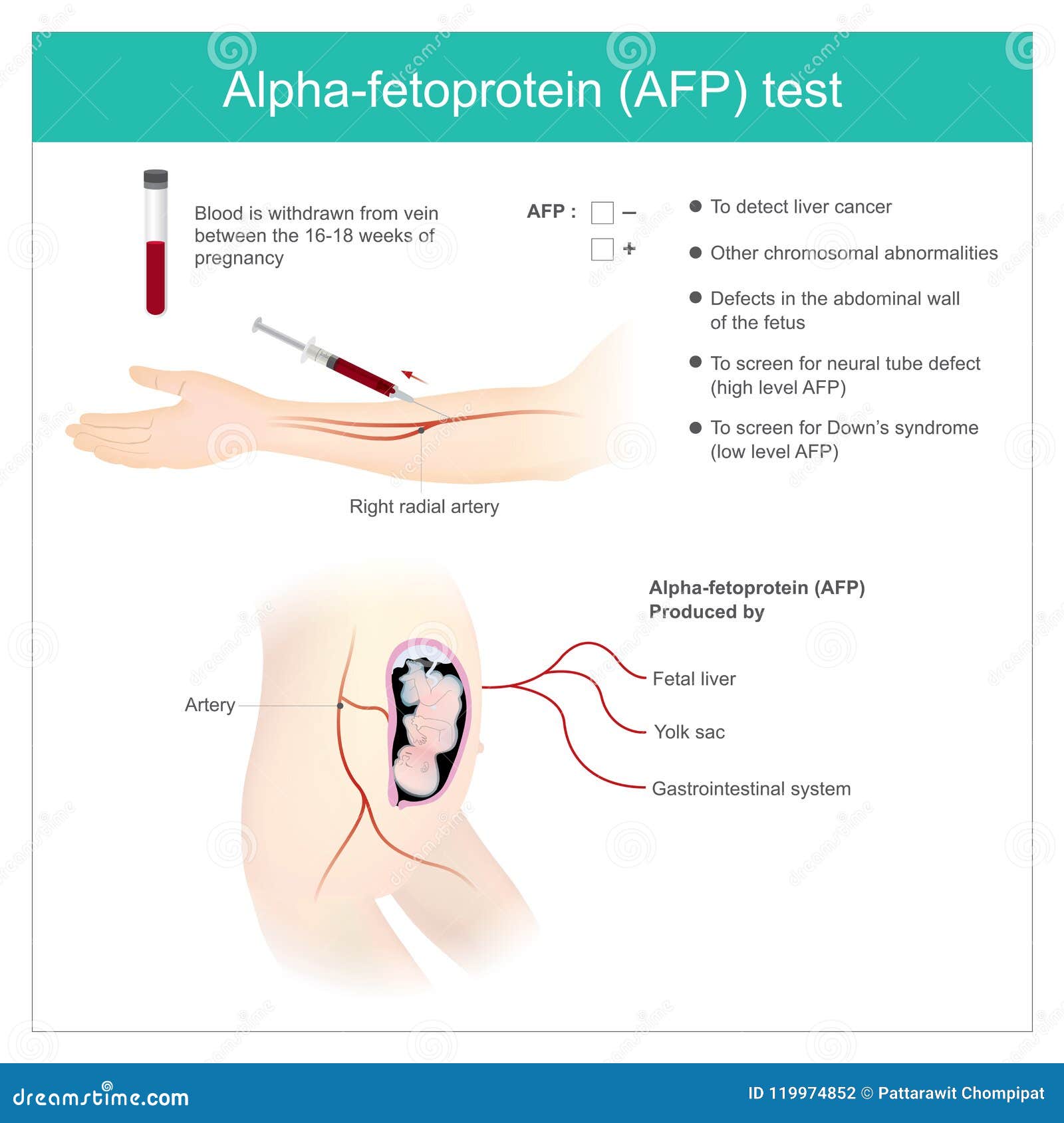 alpha-fetoprotein afp test. use analysis by afp level. to dete