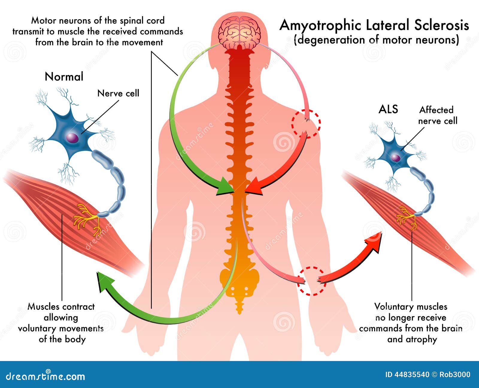 als (amyotrophic lateral sclerosis)