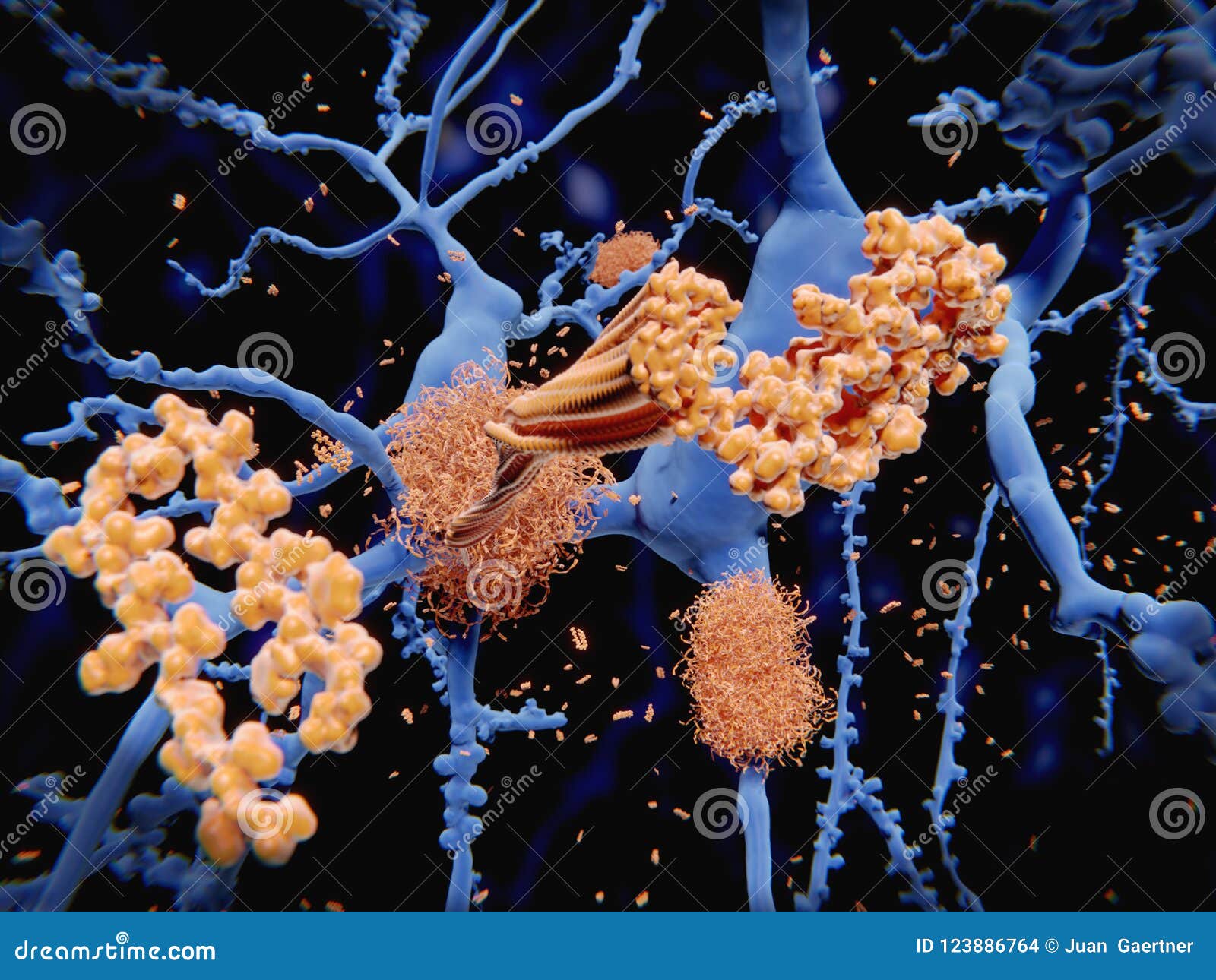 alzheimer`s disease: the amyloid-beta peptide accumulates to amy