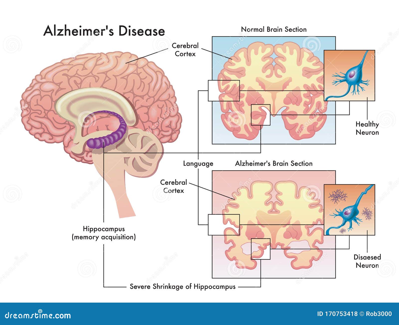 alzheimer`s disease