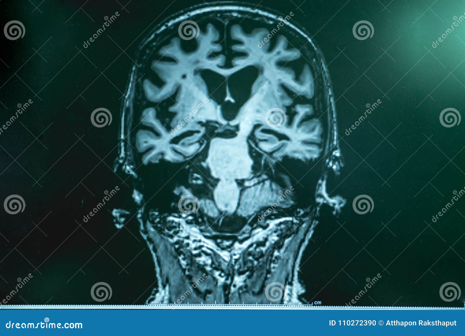 MRI Brian of Dementia Patient Stock Photo - Image of atrophy, physician
