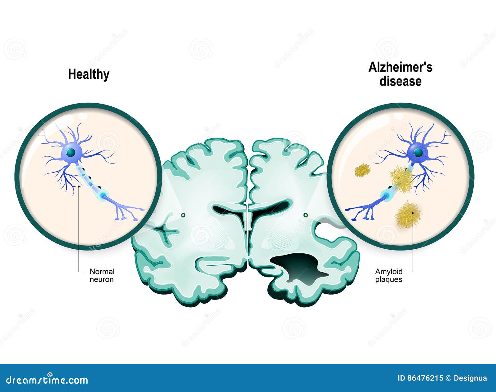 alzheimer`s disease. neurons and brain