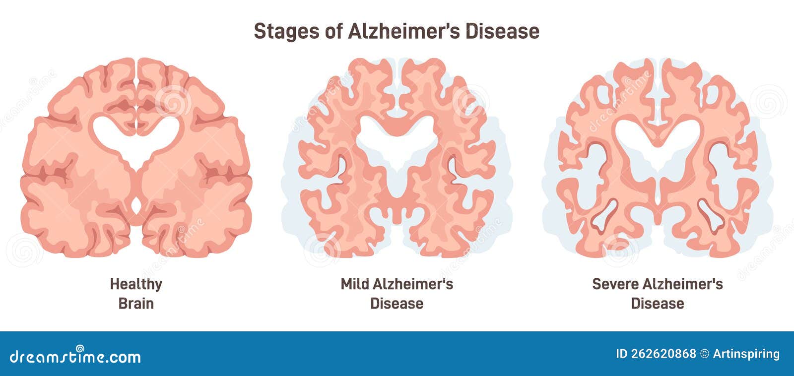 Alzheimer S Disease Stages. Human Brain Cross Section, Affected with ...