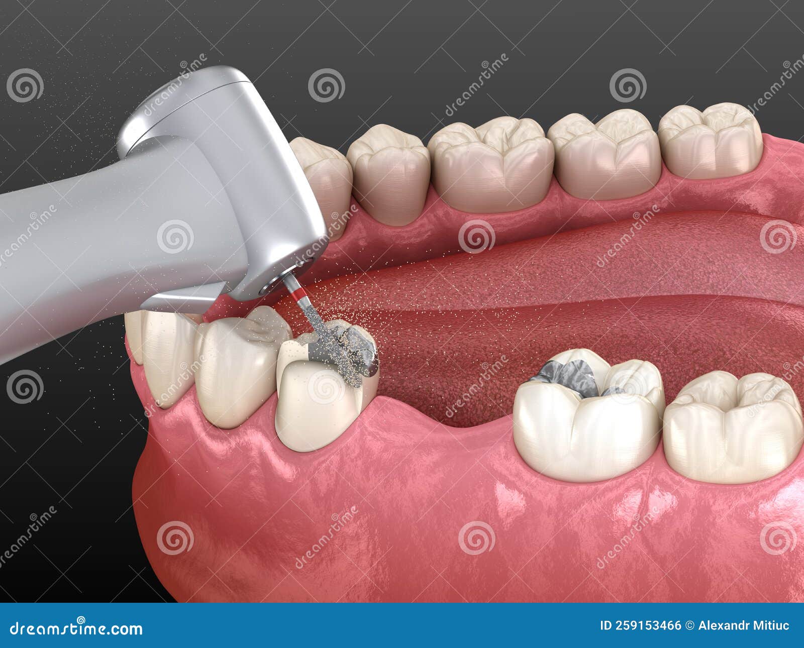 Amalgam Removing and Preparation for Ceramic Crown Placement. 3D