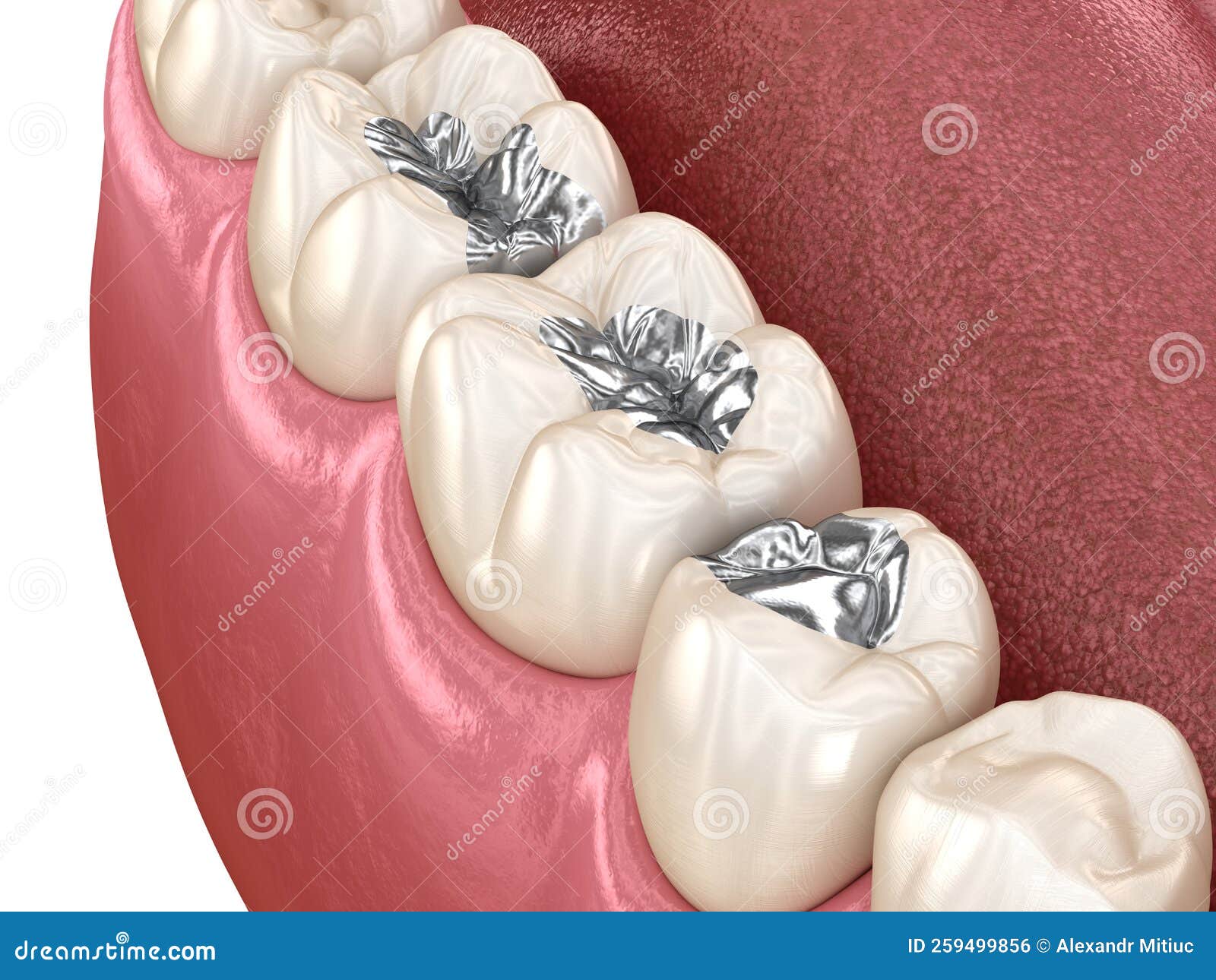 Amalgam Restoration. Medically Accurate 3D Animation of Dental Concept