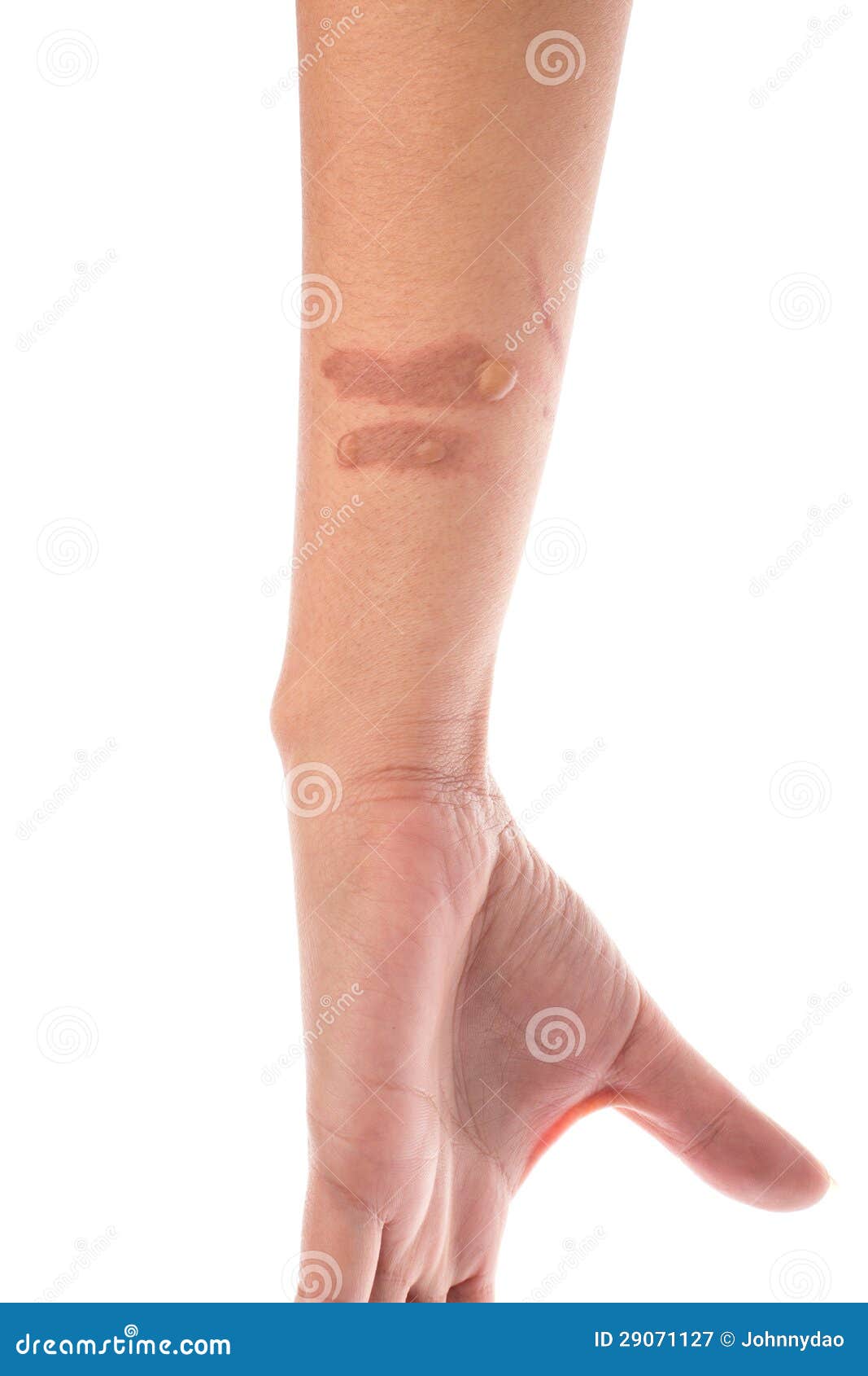 Ampoules De Brûlure Sur L'avantbras Image stock Image du peau