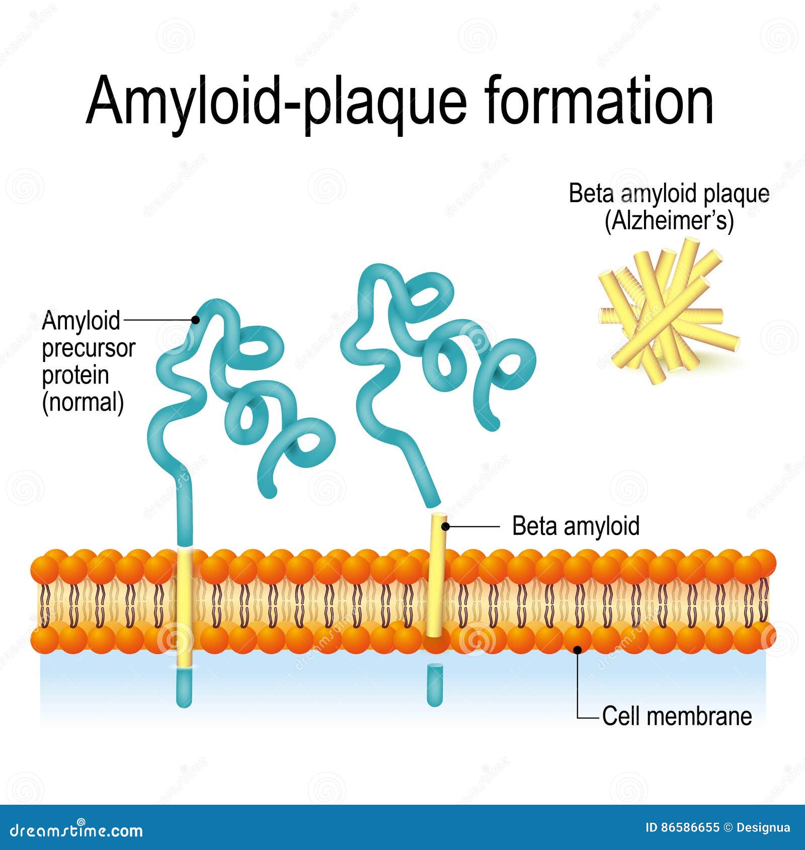 amyloid-plaque formation. alzheimer`s disease
