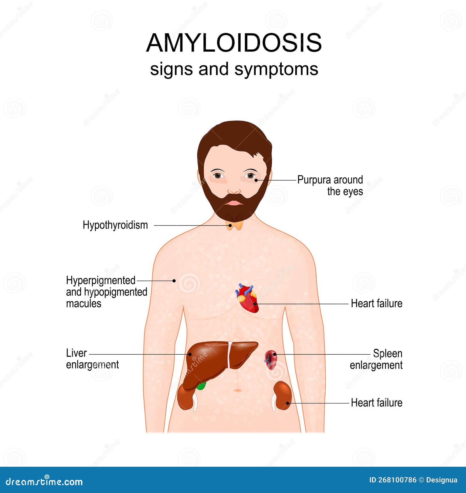 symptoms of amyloidosis