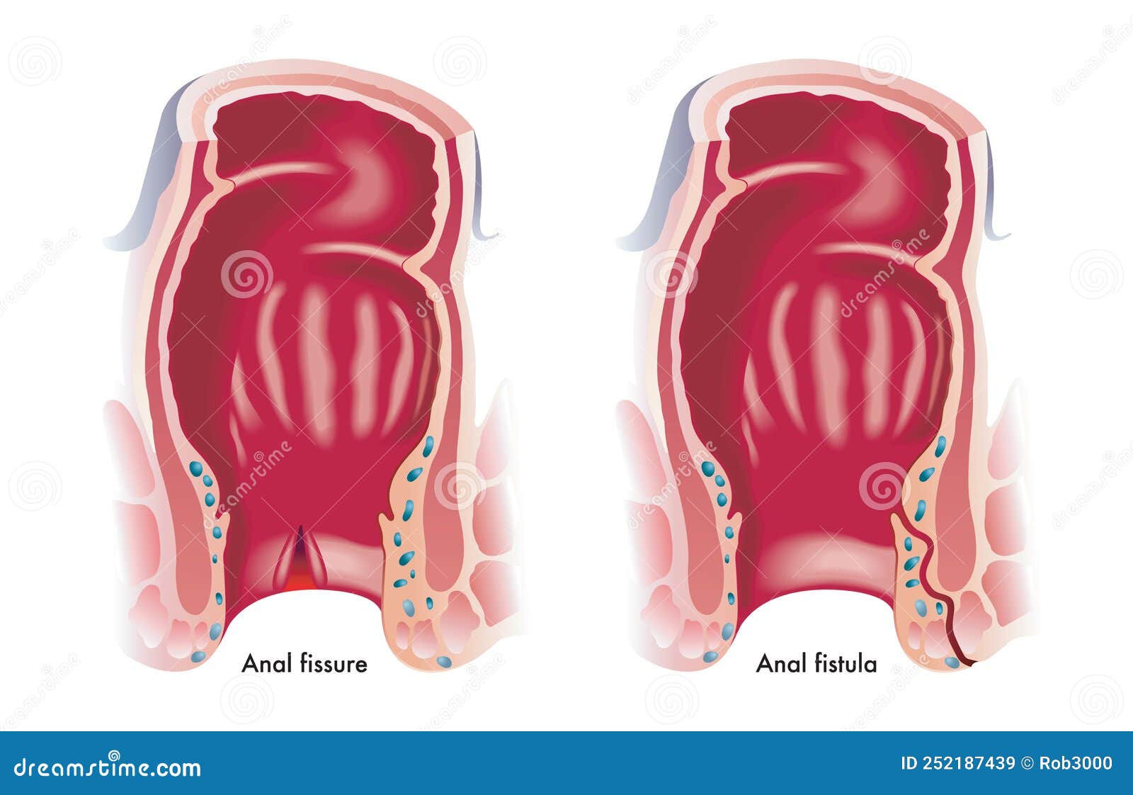 anal fissure and fistula