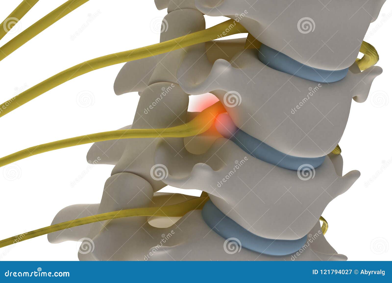 anatomically accurate3d image of cervical spine with prolapse of