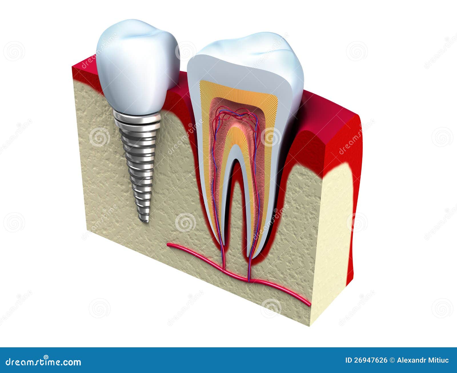 anatomy of healthy teeth and dental implant in jaw