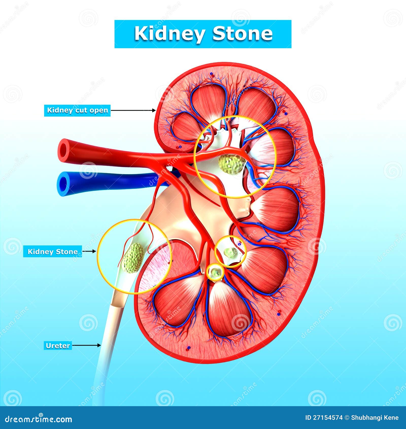 Kidney Stone Treatment Onboarding Screens Cartoon Vector