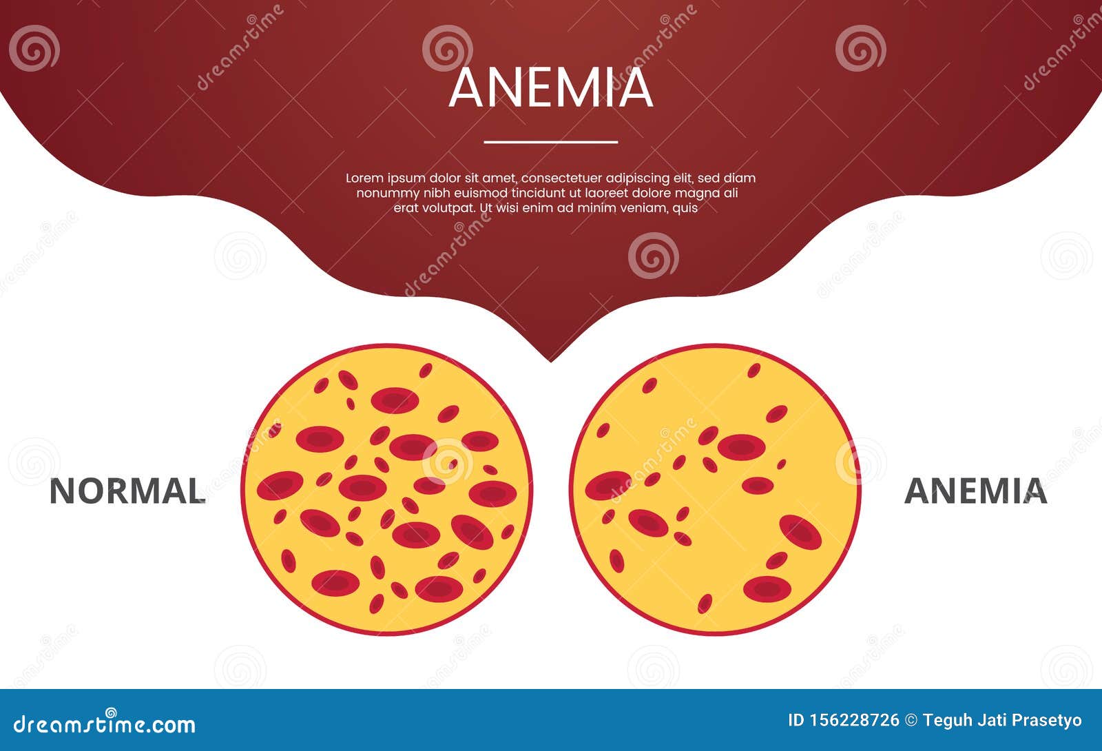Anemia System Disorder Template Anemia System Disorder Template