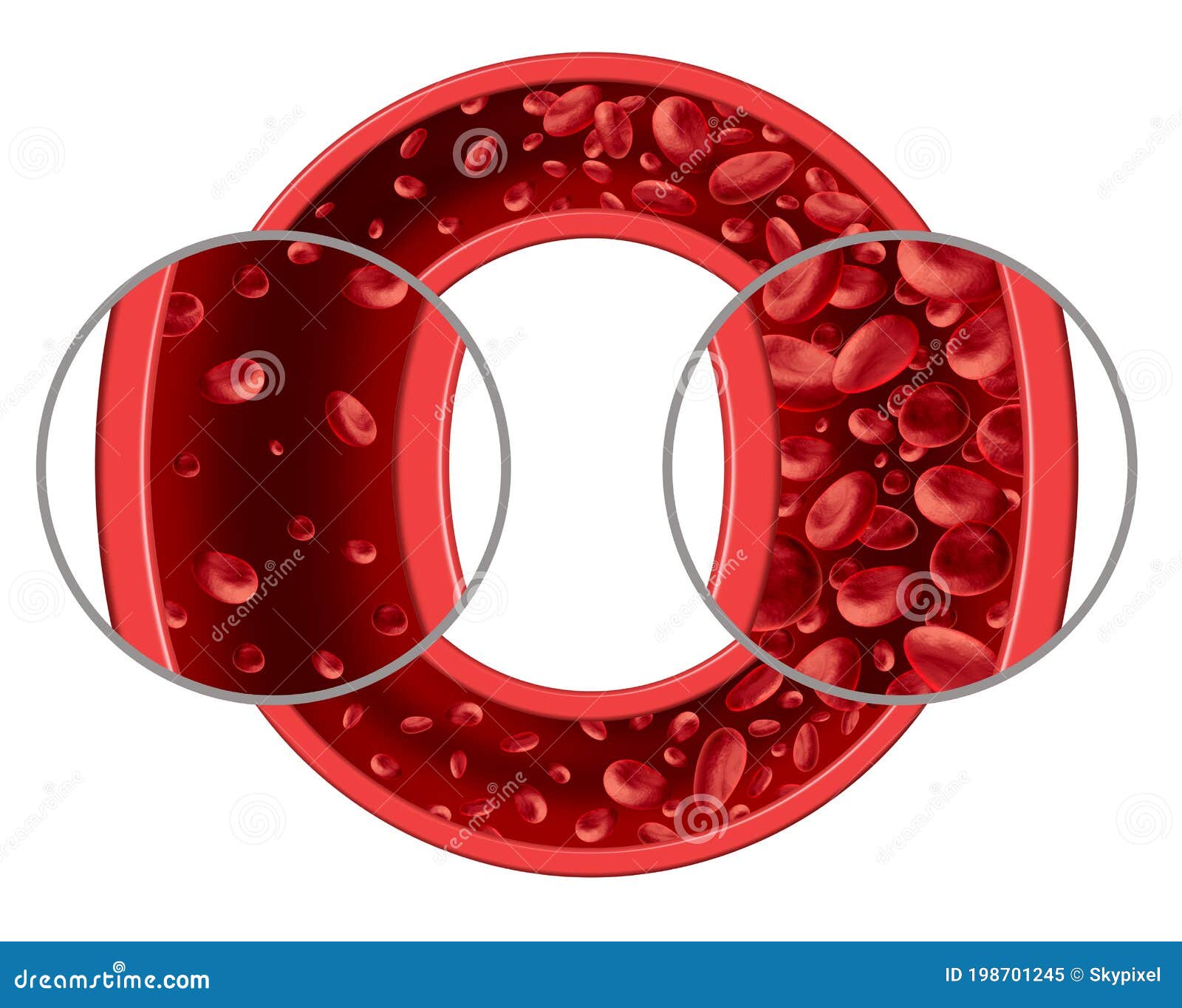 Anemia Blood Disease stock illustration. Illustration of chronic