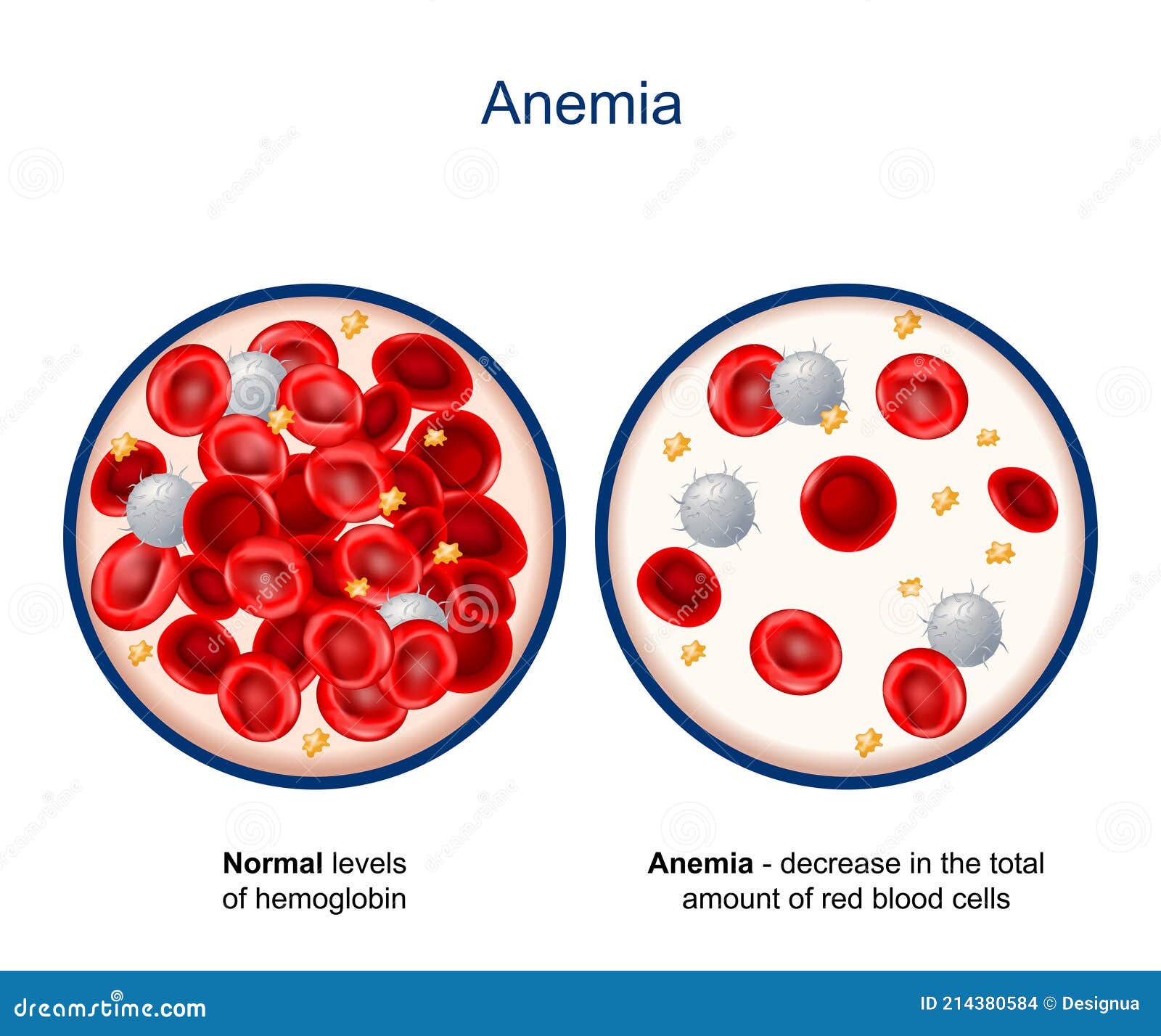 anemia. close-up of blood vessel with erythrocyte, platelets and white blood cells lymphocytes