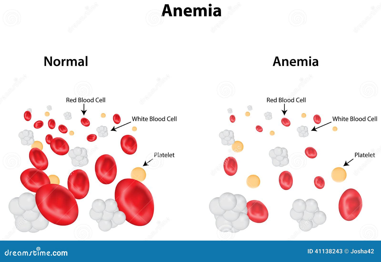 anemia diagram