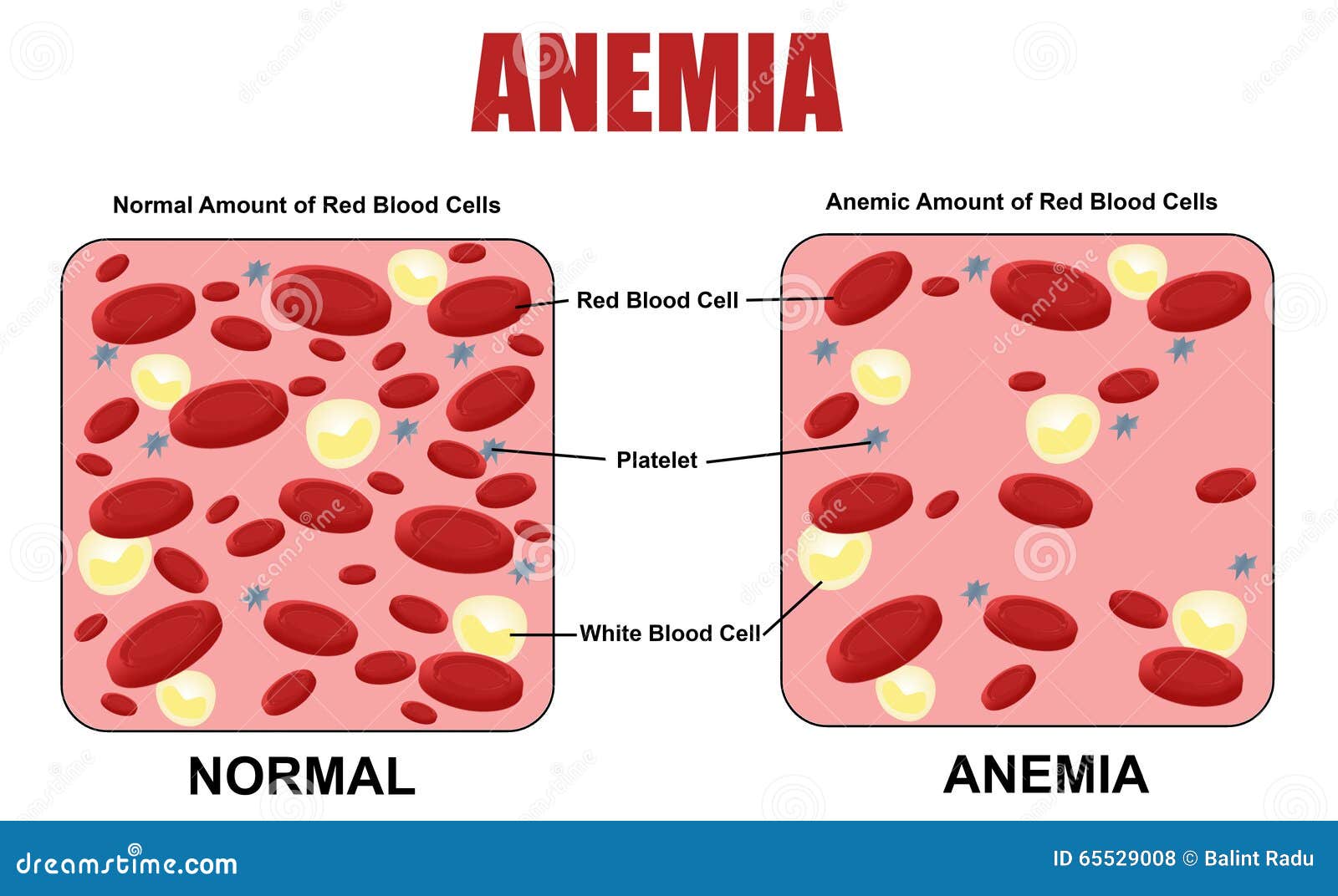 anemia diagram