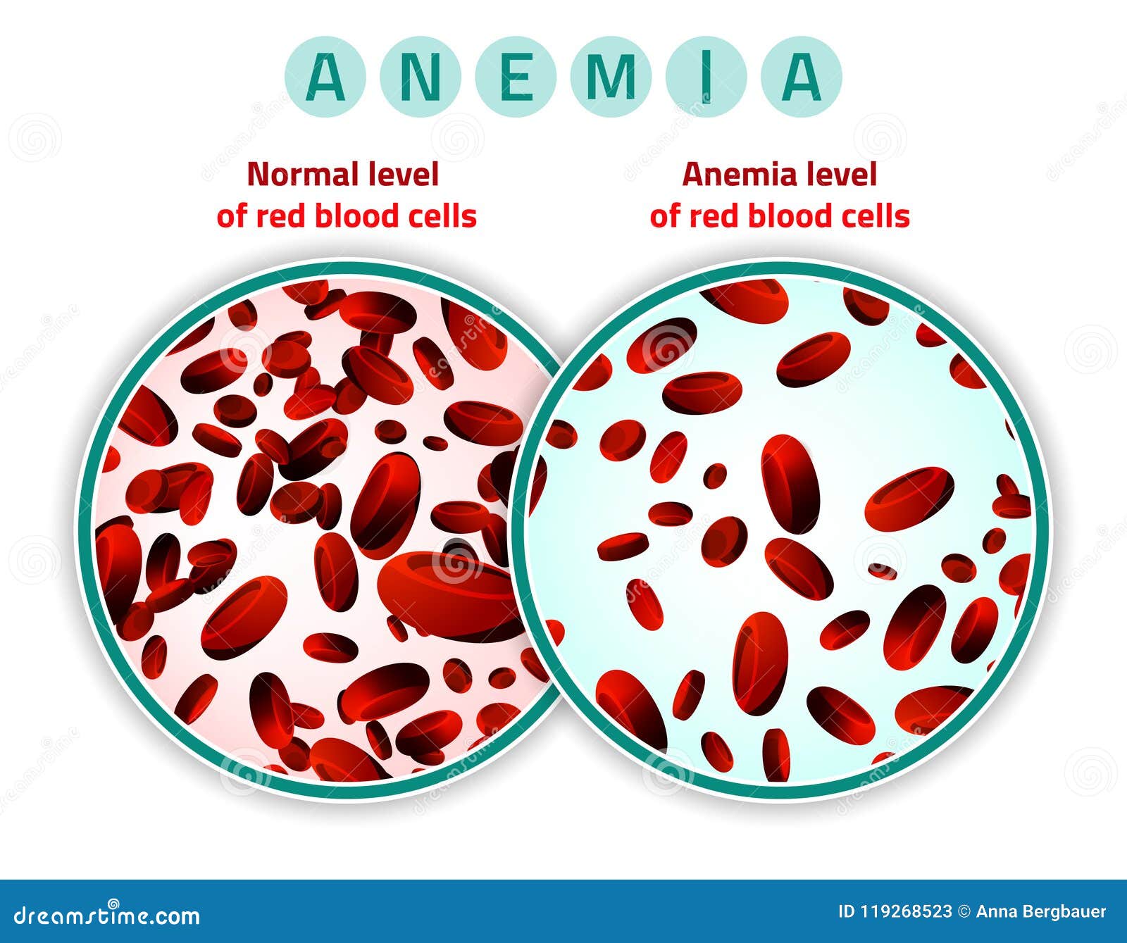 Anemia Cartoons, Illustrations & Vector Stock Images - 2583 Pictures to