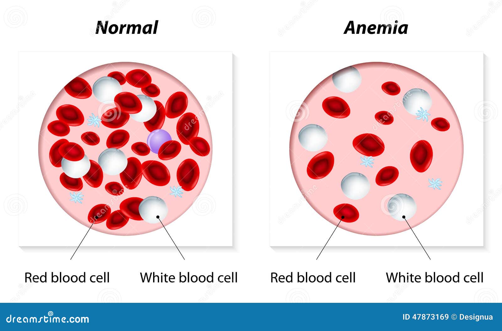 Анемия мышцы. Эритроциты при железодефицитной анемии. Клетки крови при анемии. Железодефицитная анемия животных симптомы. Красные клетки крови.