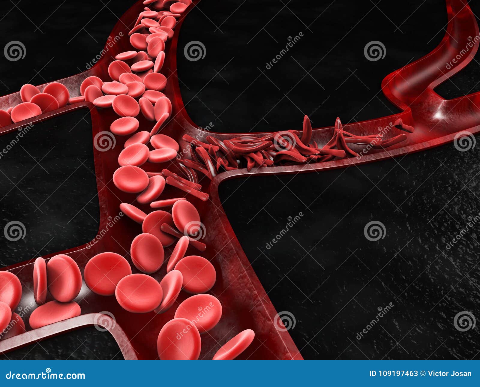 anemia, sickle cell and normal red blood cell, 3d 