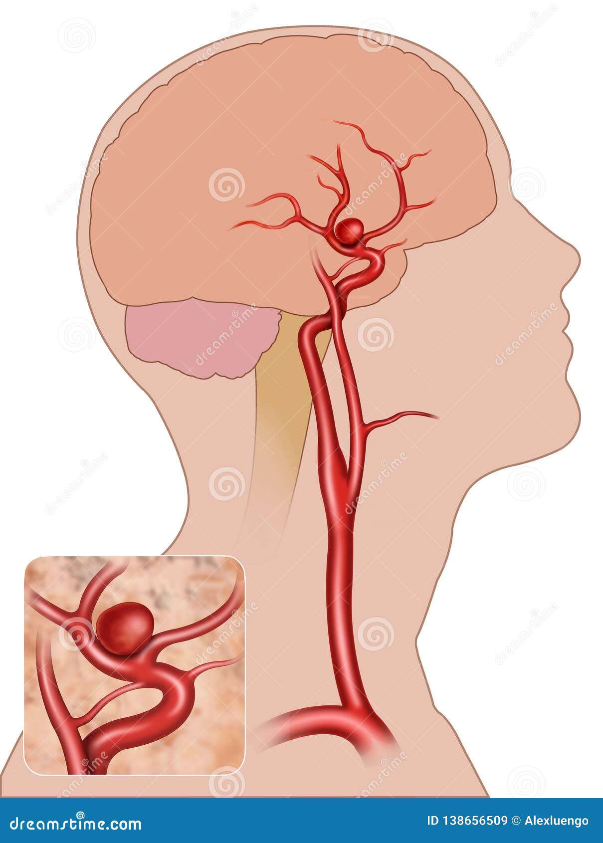 aneurisma fusiforme cerebral