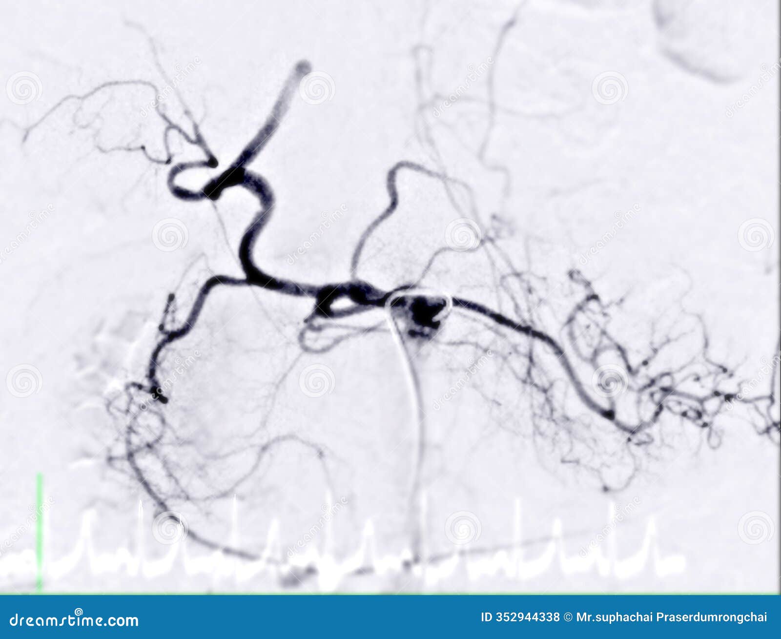 the angiographic view of the hepatic artery during embolization. the highlighted red vessels demonstrate targeted blood flow