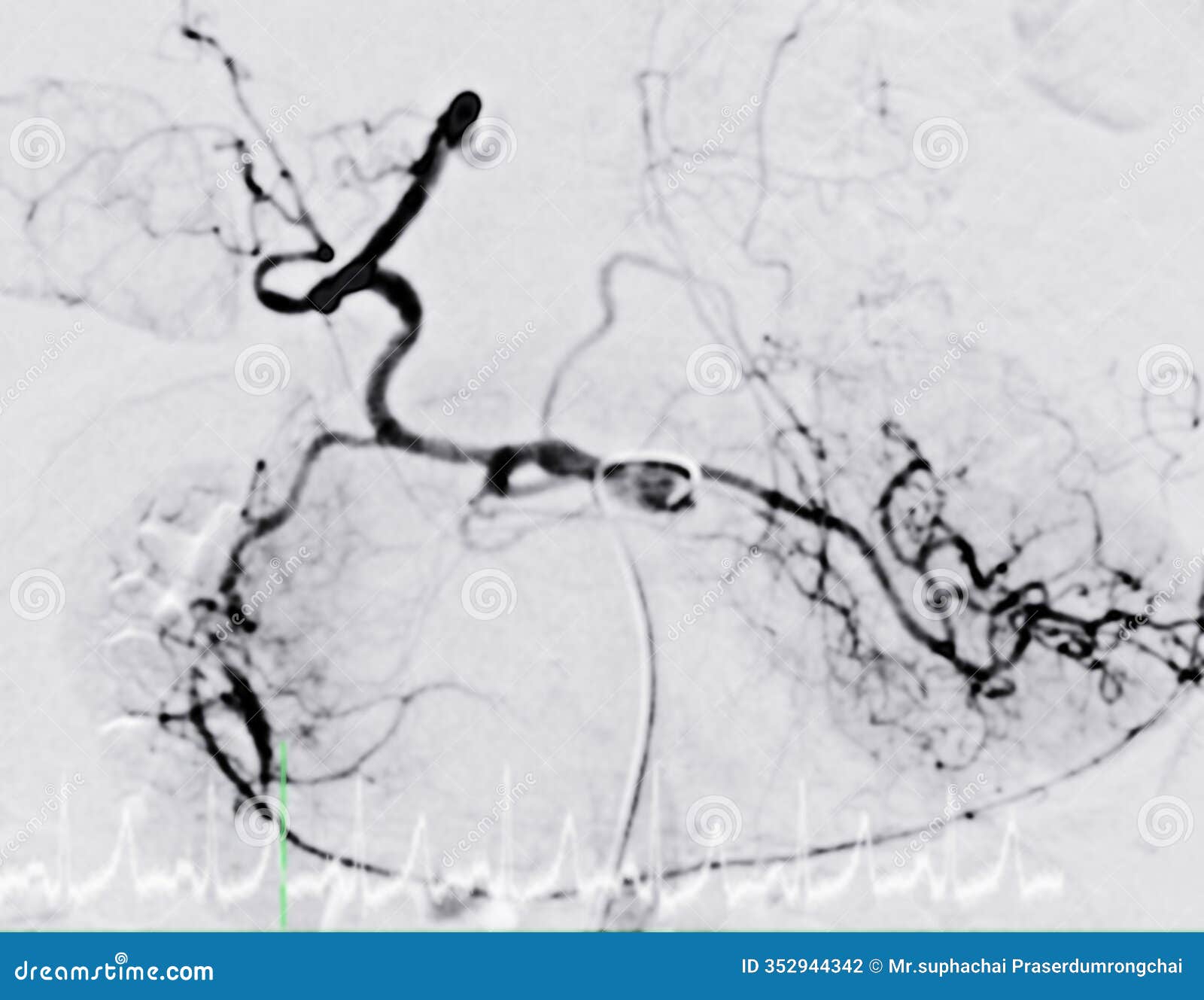 the angiographic view of the hepatic artery during embolization. the highlighted red vessels demonstrate targeted blood flow