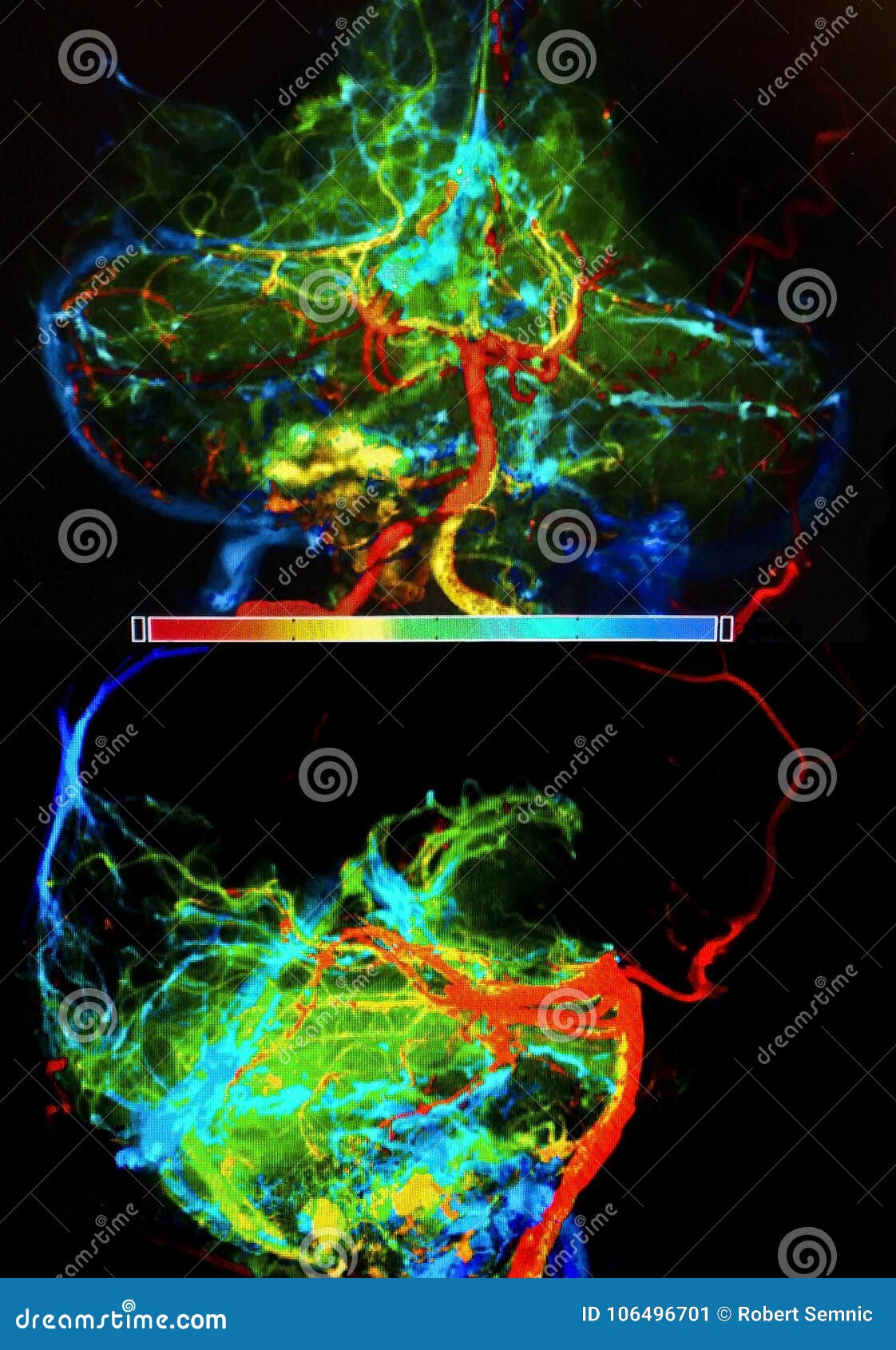 brain arteries an veins, angiography