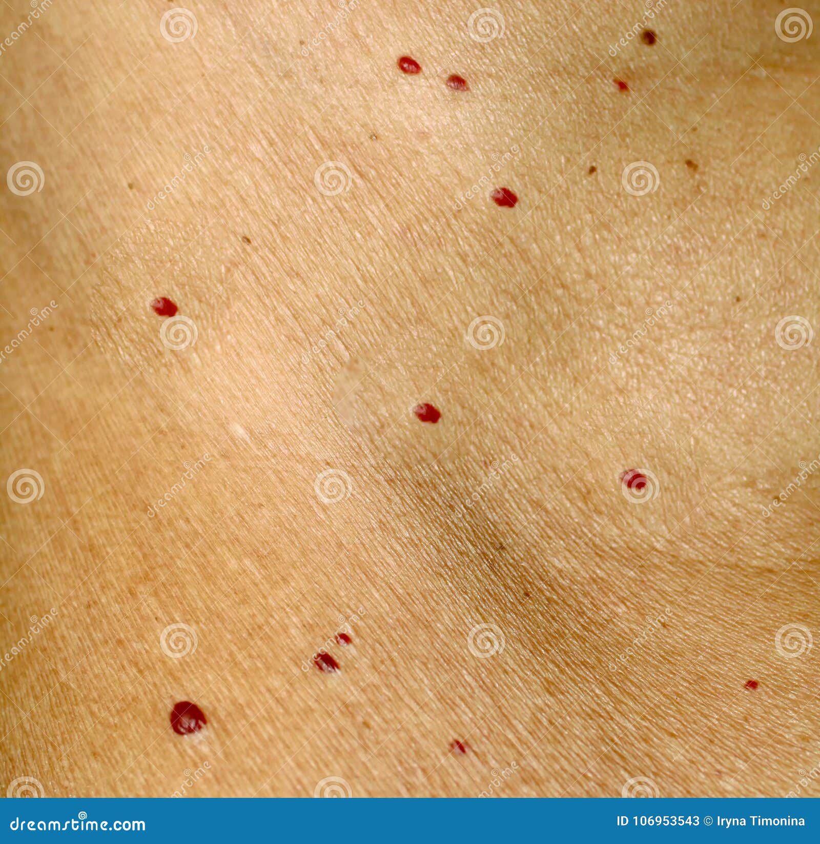 Angioma Sulla Pelle Talpe Rosse Sul Corpo Molte Voglie Immagine Stock