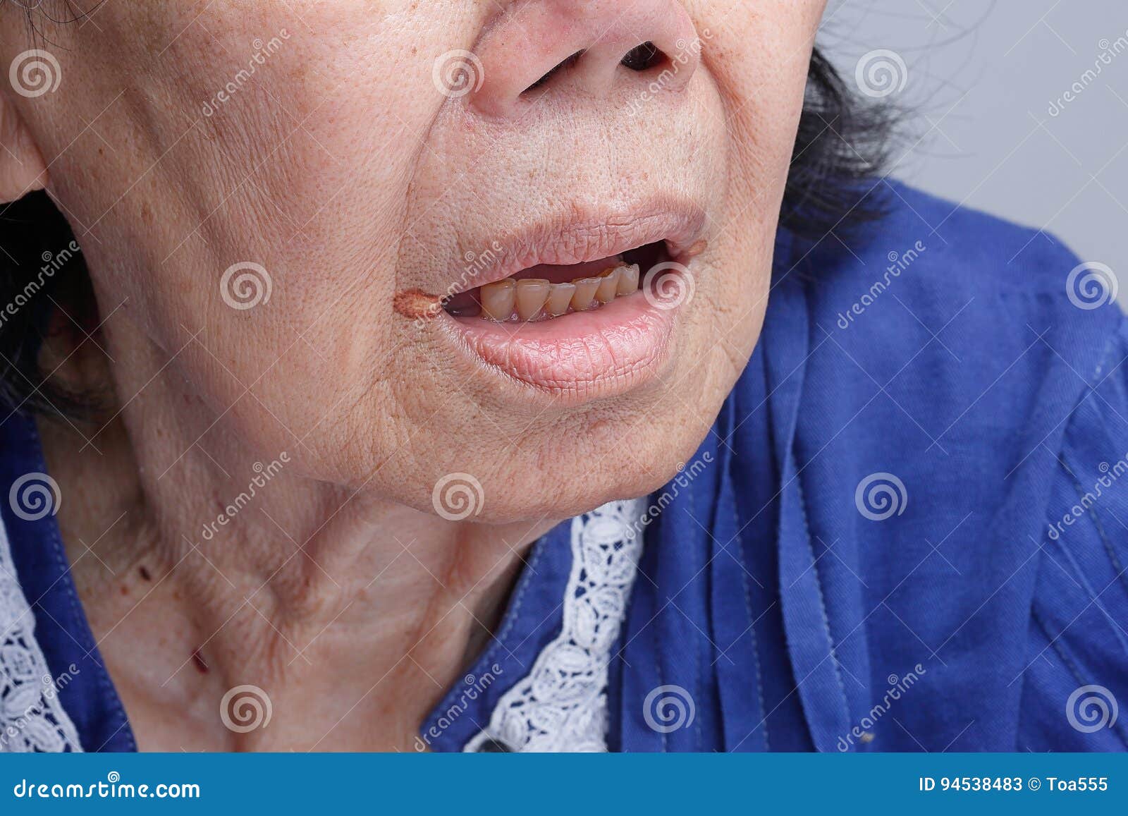 Angular Cheilitis or Inflammation of the Lips Stock Image Image of