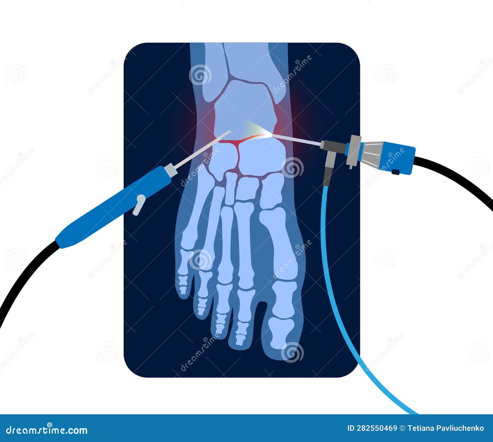 Ankle Arthroscopy Poster Cartoon Vector | CartoonDealer.com #282550469