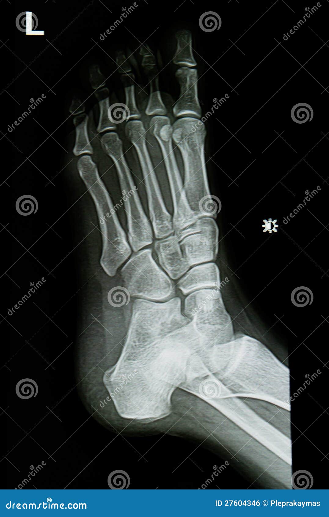 Ankle xrays image stock photo. Image of clinic, examination 27604346