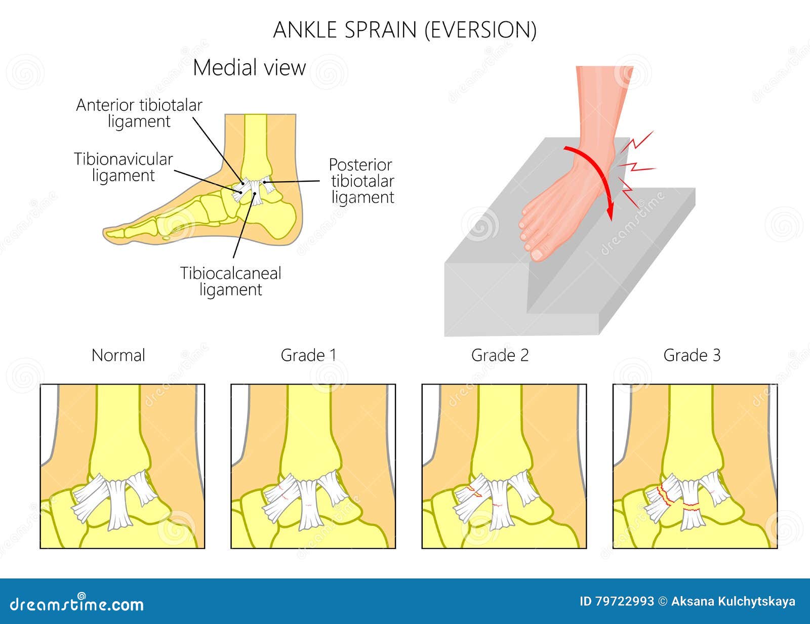 Ankle sprain.Eversion stock vector. Illustration of podiatry - 79722993