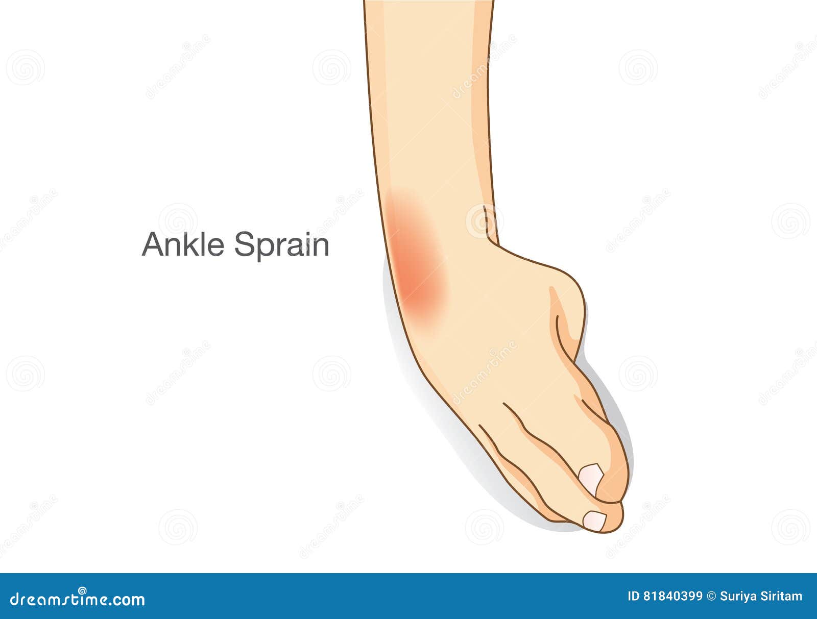 Ankle Cartoon Sprain Stock Illustrations – 77 Ankle Cartoon Sprain Stock Illustrations, Vectors & Clipart - Dreamstime Ankle Cartoon Sprain Stock Illustrations – 77 Ankle Cartoon Sprain Stock Illustrations, Vectors & Clipart - Dreamstime