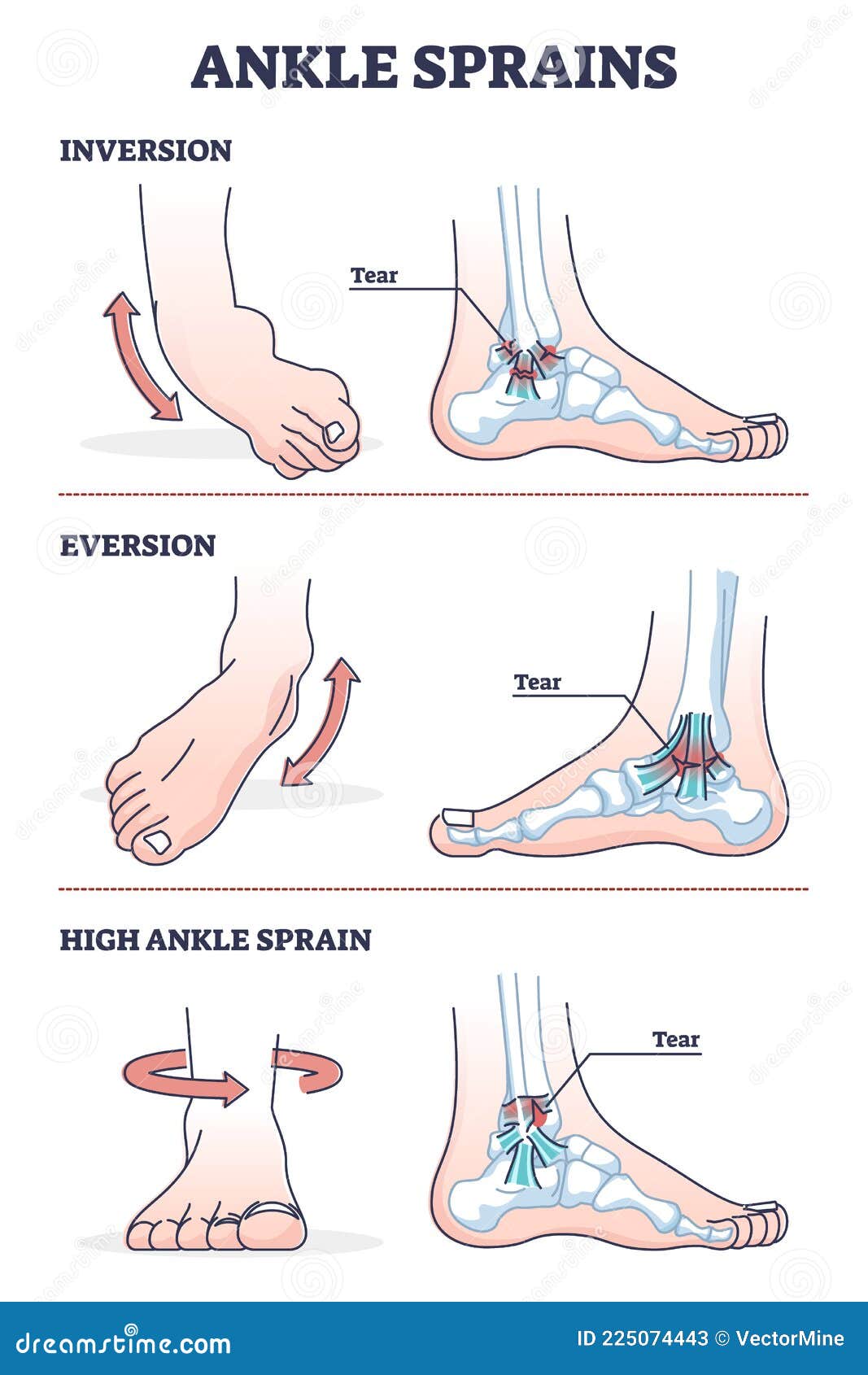 ankle sprains situations with inversion and eversion injury outline diagram