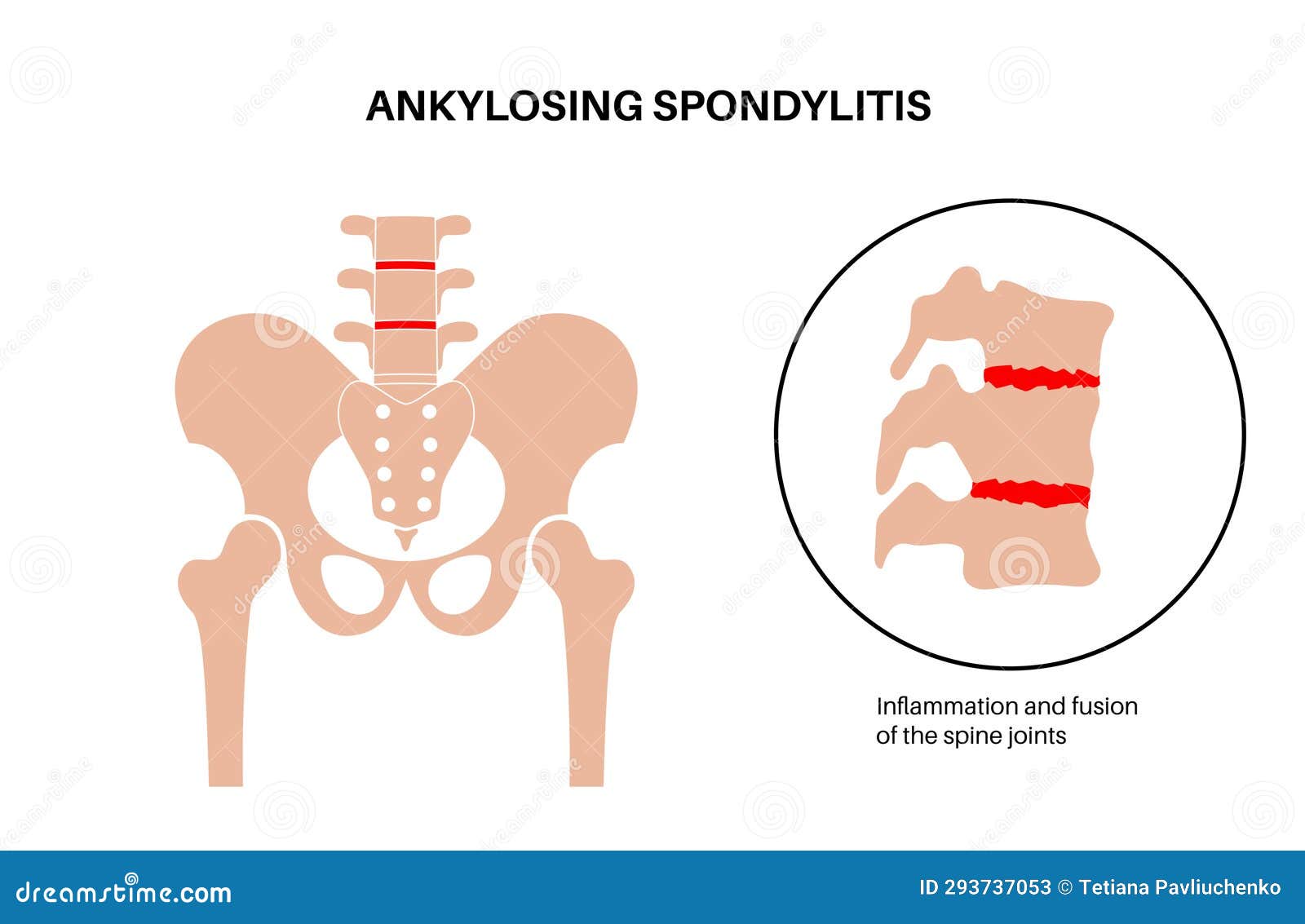 ankylosing spondylitis disease