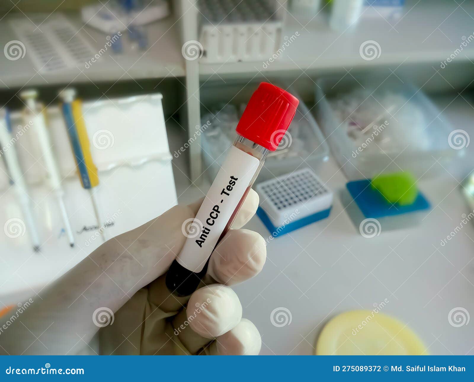 What Is the Anti-Cyclic Citrullinated Peptides (Anti-CCP) Blood Test?